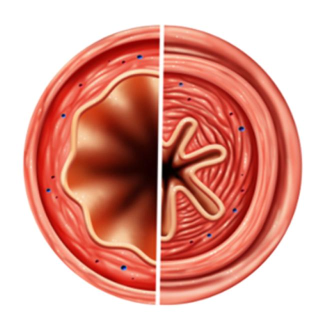 treatment inflammation in the airways